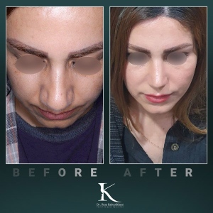 rhinoplasty-54