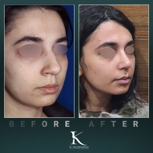 rhinoplasty-55