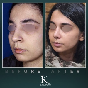 rhinoplasty-56