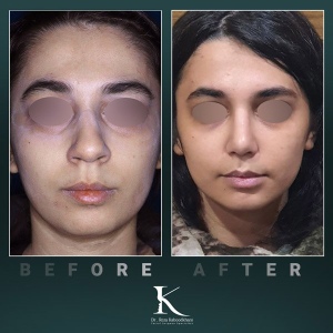 rhinoplasty-57