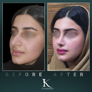rhinoplasty-58