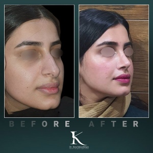 rhinoplasty-59