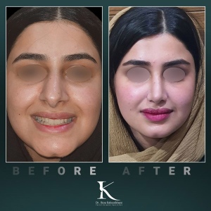 rhinoplasty-60
