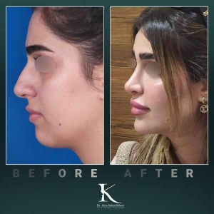 rhinoplasty-64