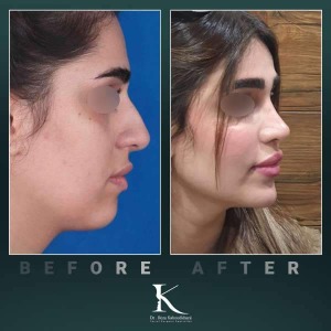 rhinoplasty-65