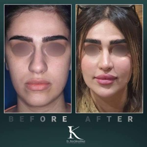 rhinoplasty-66