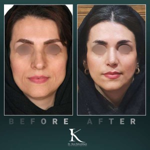 rhinoplasty-67