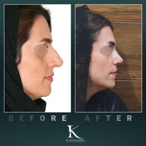 rhinoplasty-68