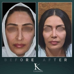 rhinoplasty-70
