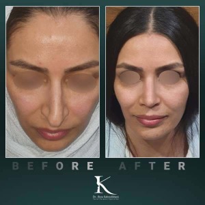 rhinoplasty-71