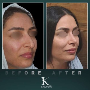rhinoplasty-72