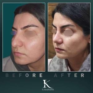 rhinoplasty-73