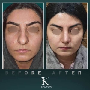 rhinoplasty-74