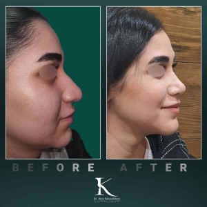rhinoplasty-75