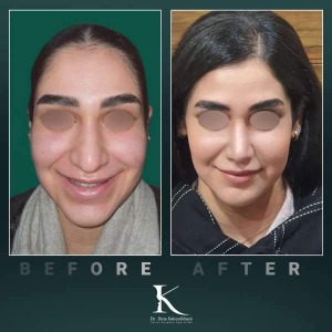 rhinoplasty-76