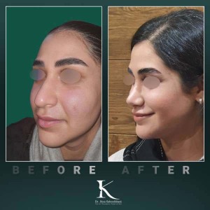rhinoplasty-77