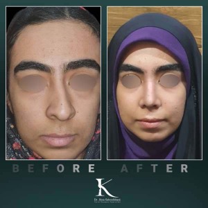 rhinoplasty-78