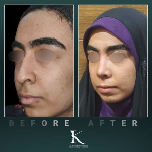 rhinoplasty-79