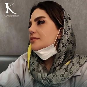 rhinoplasty-8
