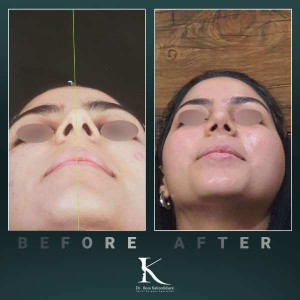 rhinoplasty-80
