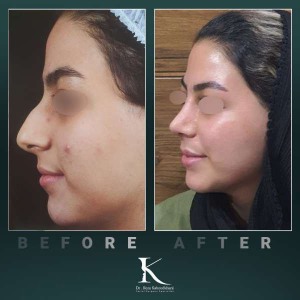 rhinoplasty-81