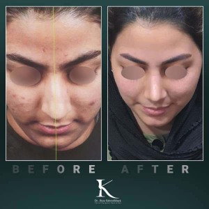 rhinoplasty-82