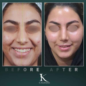 rhinoplasty-83