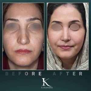 rhinoplasty-84