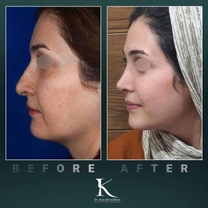 rhinoplasty-85