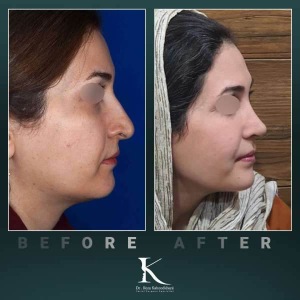 rhinoplasty-86