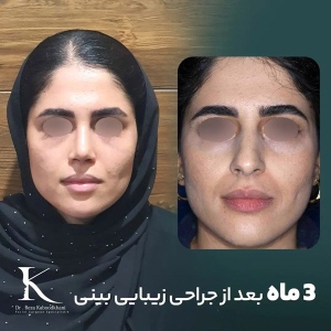 rhinoplasty-9