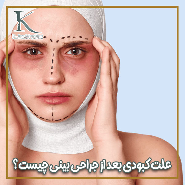 کبودی بعد از جراحی بینی