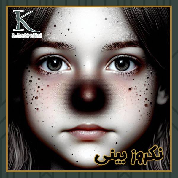 نکروز بینی - https://drkaboodkhani.com/