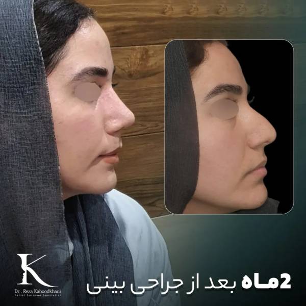 عکس جراحی بینی