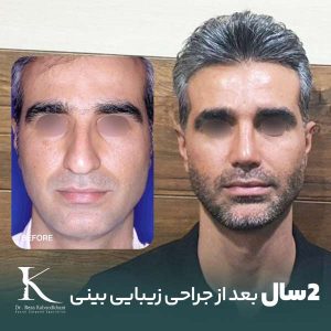 نمونه کار جراحی بینی در شیراز