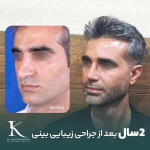 عکس عمل بینی در شیراز بعد از دوسال