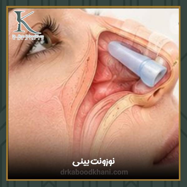 نوزونت بینی بعد از عمل